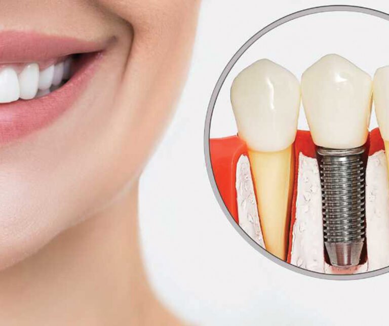 Dental Implants Canton MA