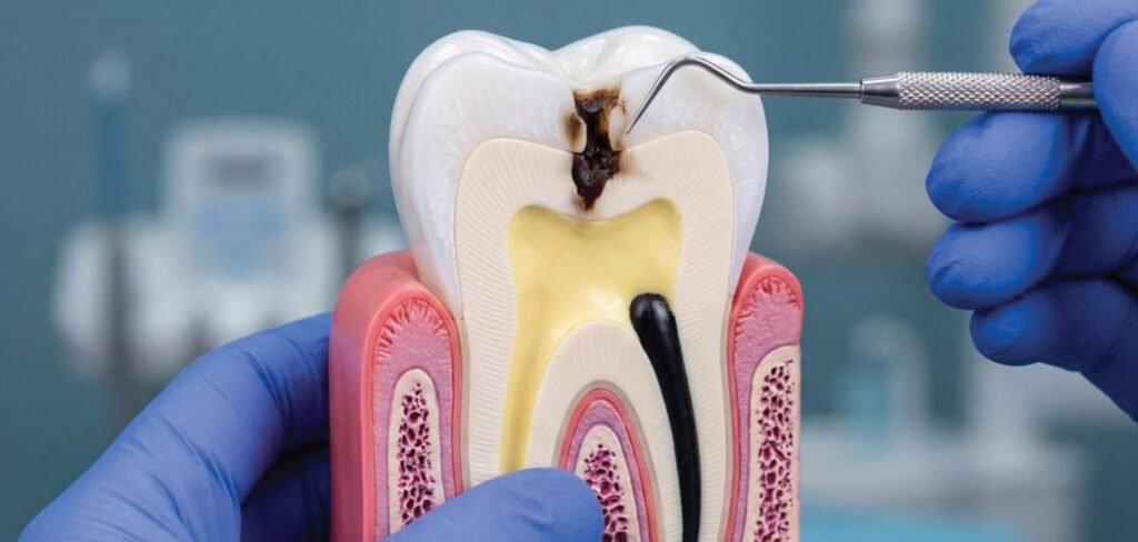 Tooth anatomy showing infected pulp and root canal