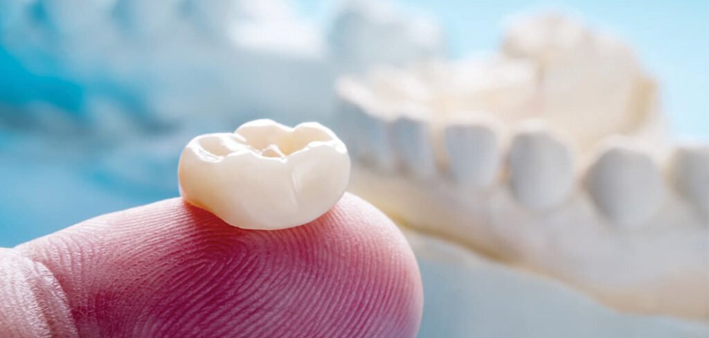 Dental filling fall out treatment with a dental crown