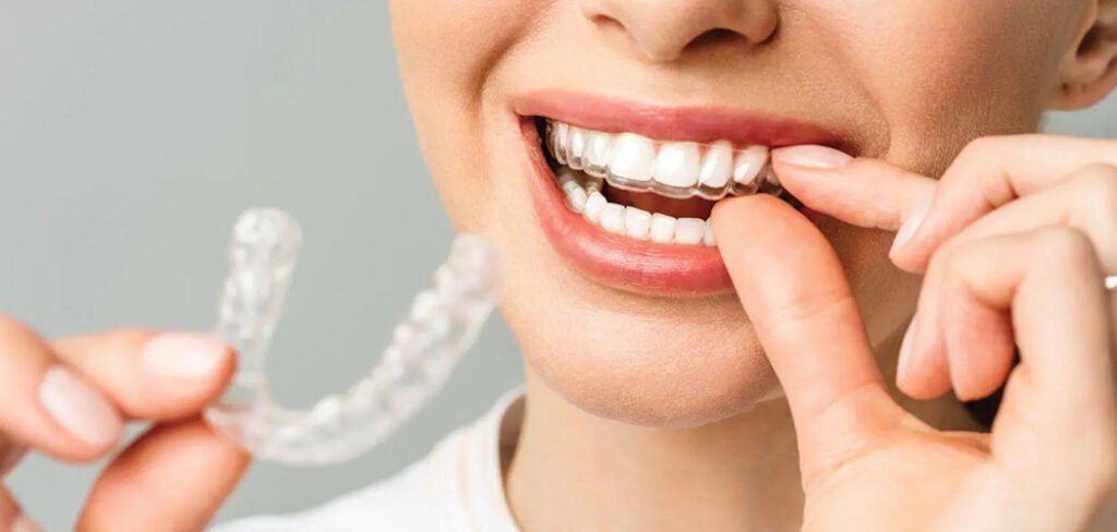 patient placing a mouthguard to help prevent dental emergencies