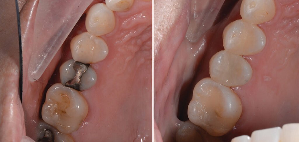 Before and after dental filling