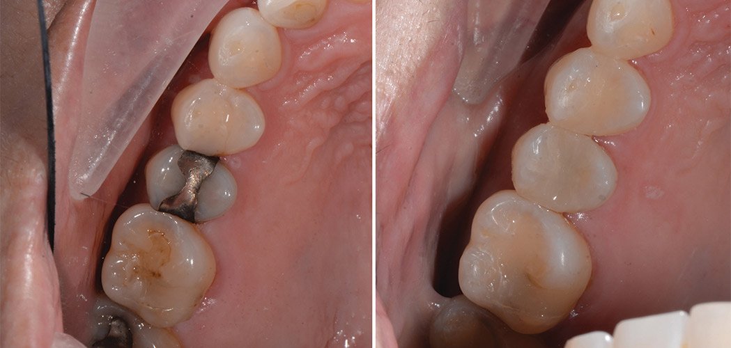 Before and after dental filling