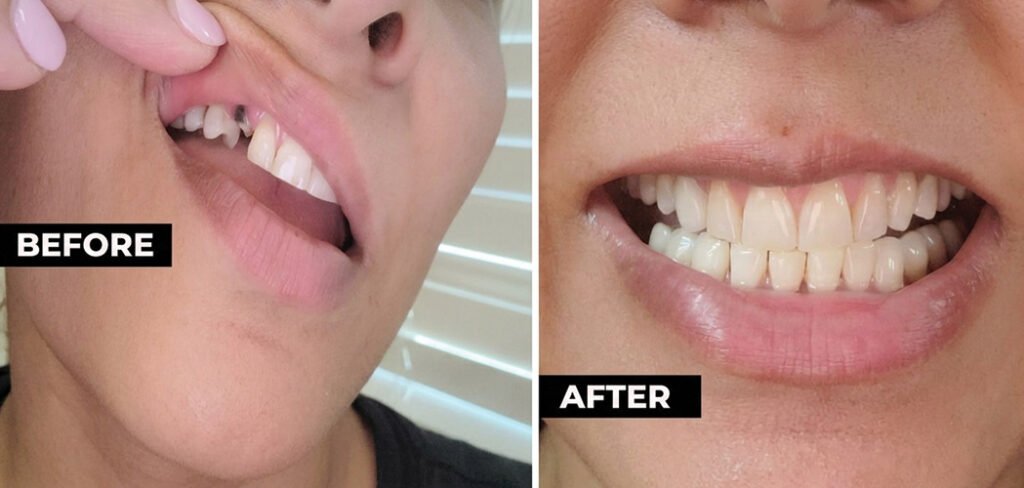 Temporary Tooth Bridge