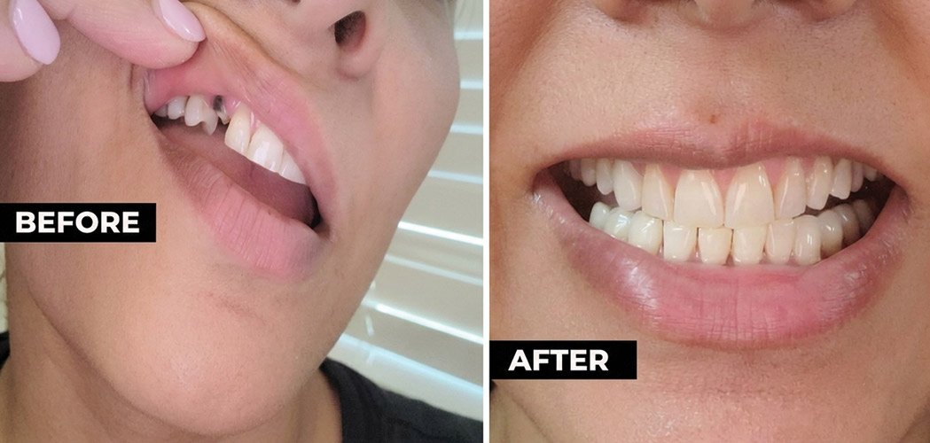 Temporary Tooth Bridge