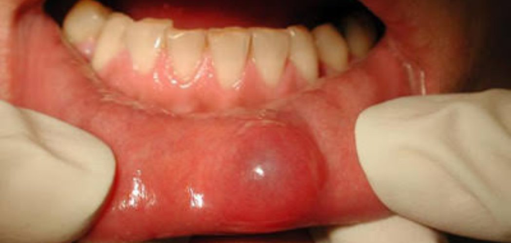 bump on lip