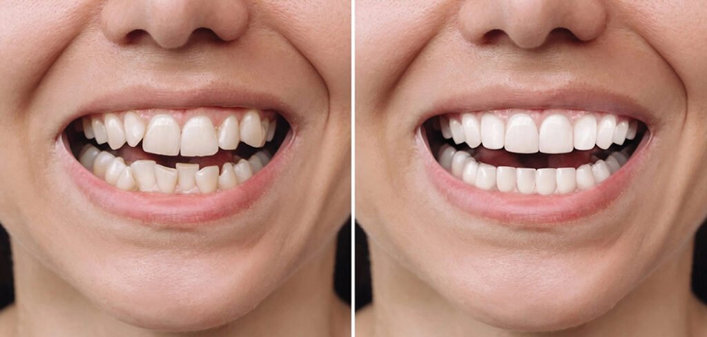 Veneers Before and After Crooked Teeth