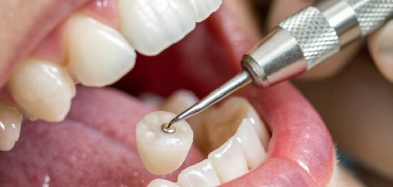 Price of Dental Cap