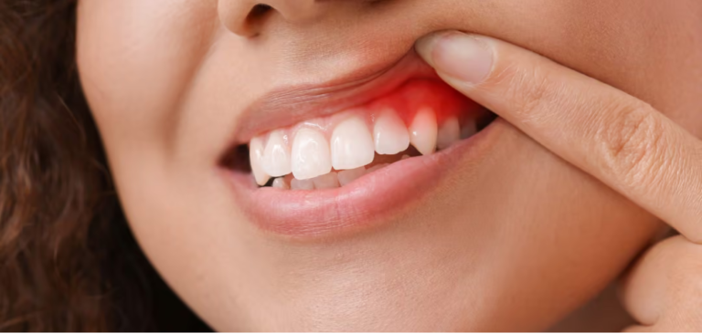 Gum is red