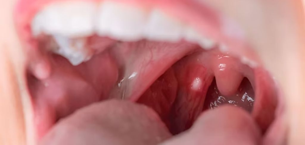  roof of your mouth hurts