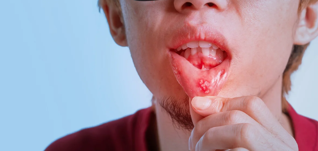Roof of Mouth Hurts