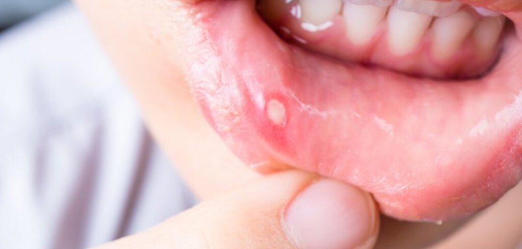 white pimples on inside of lips