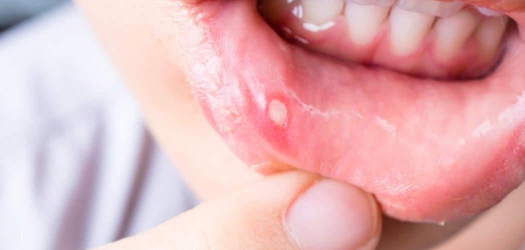 white pimples on inside of lips