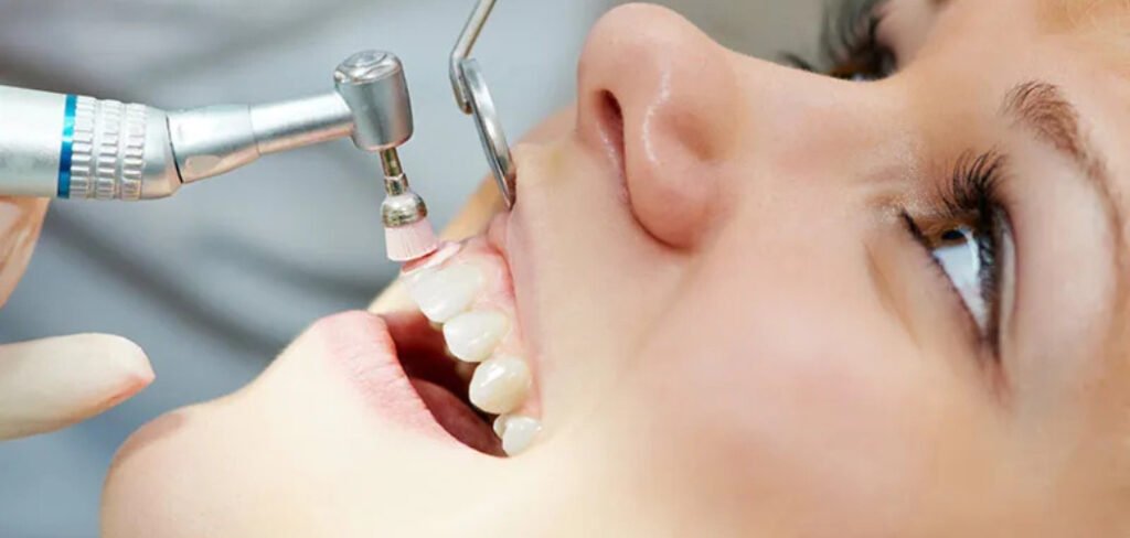 dental prophy