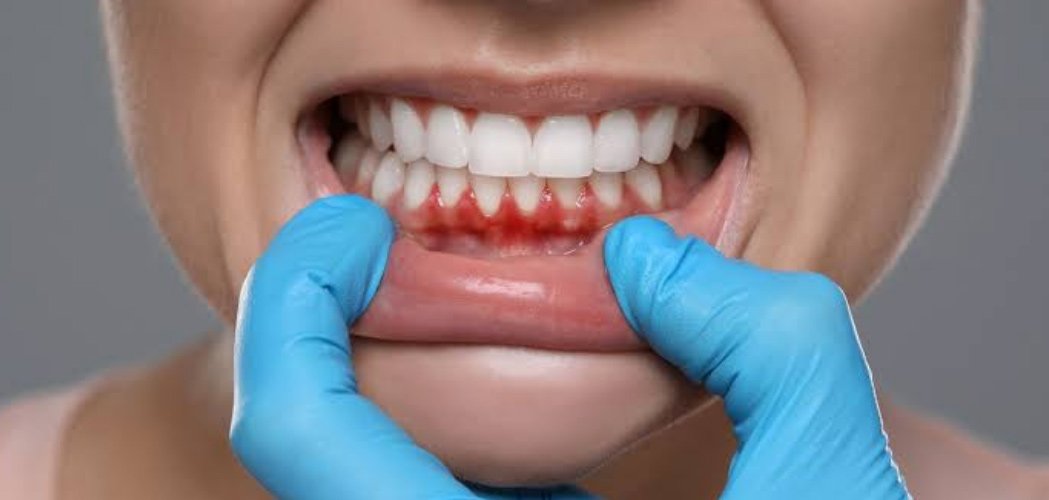 Gum disease stages 
