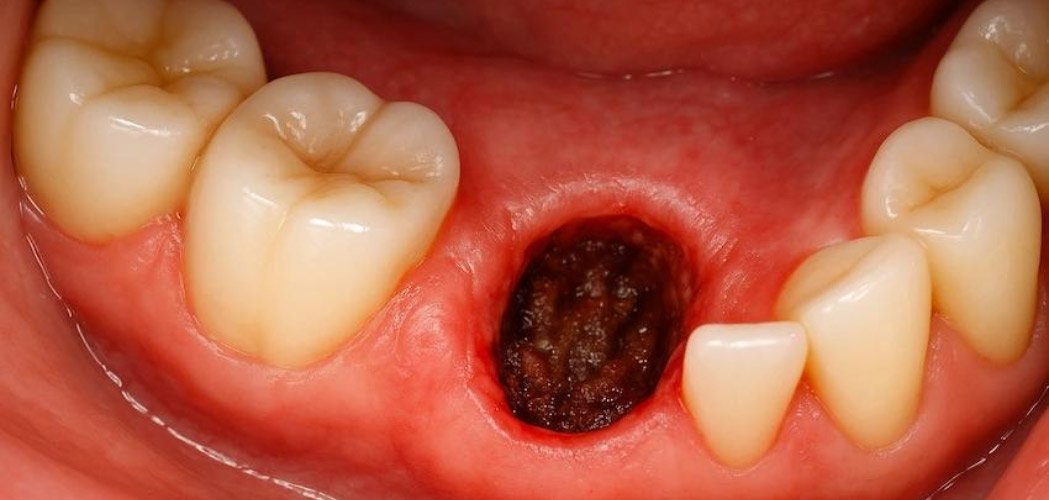 how to prevent dry socket