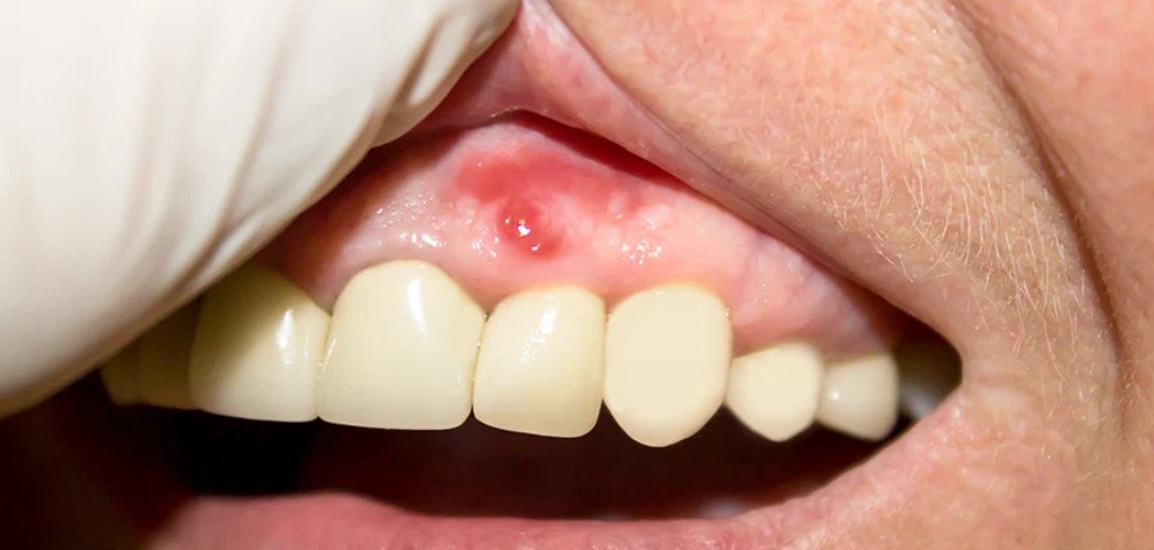 Periodontal disease 