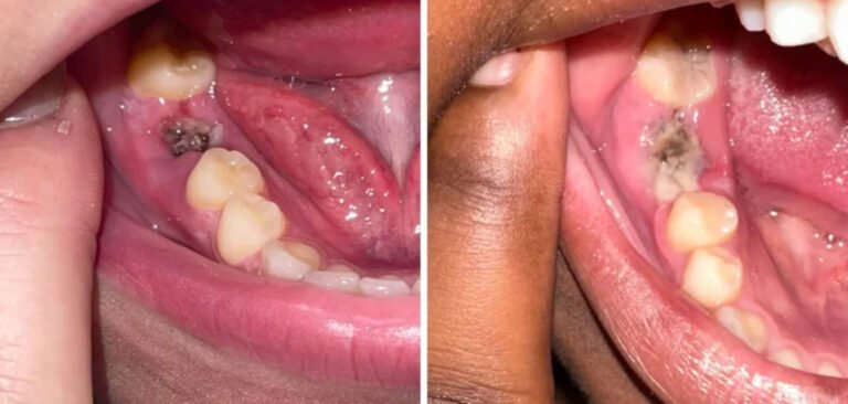 how to prevent dry socket