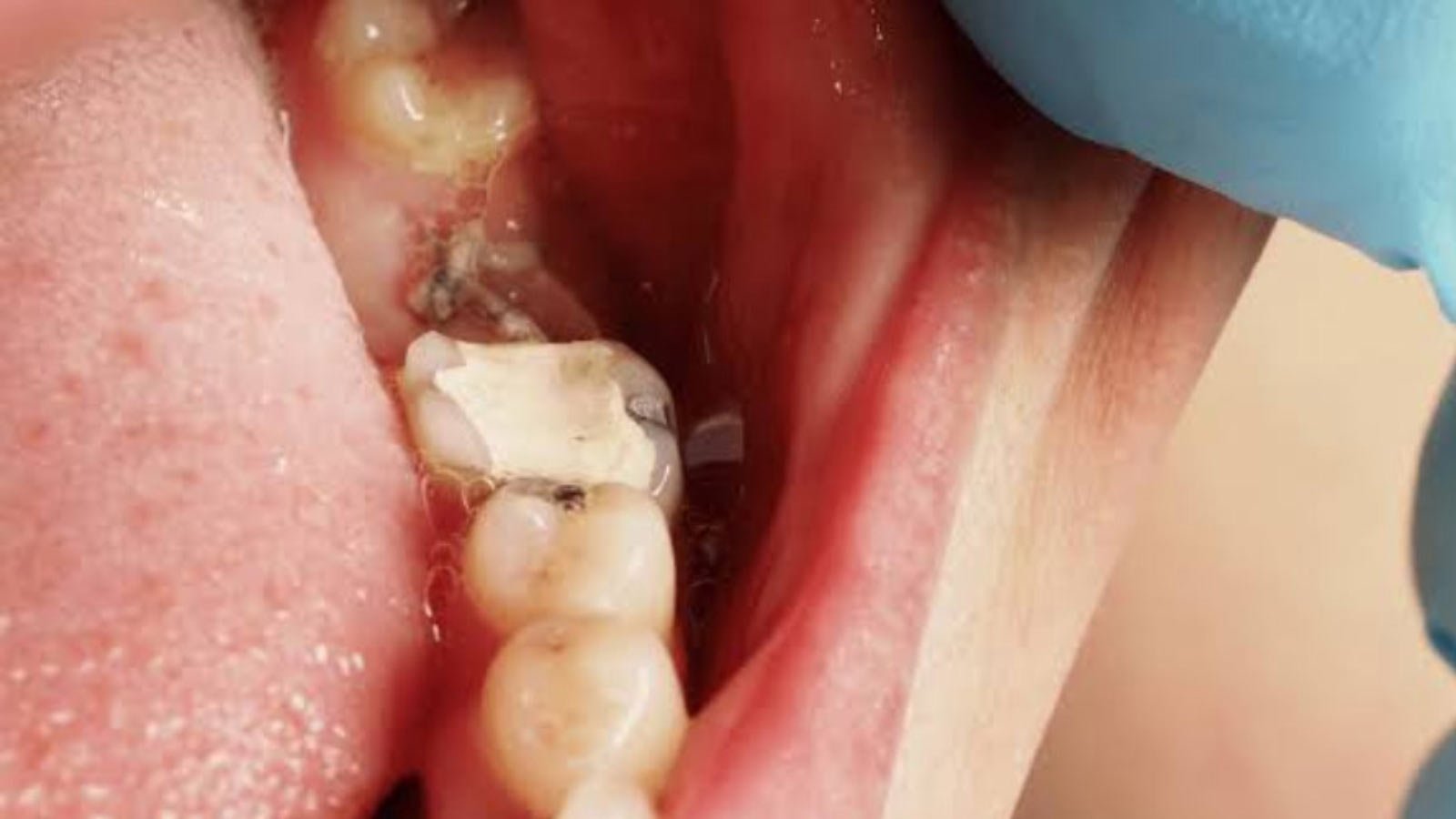 how to tell if you have a cavity