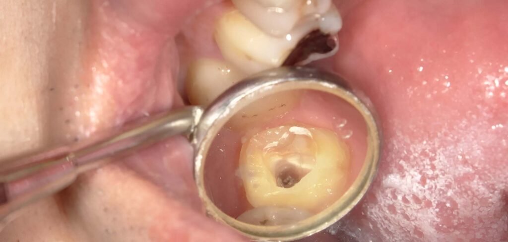 cracked tooth root 