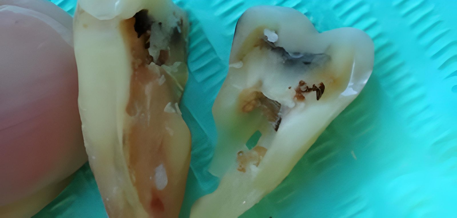 A cracked tooth root 