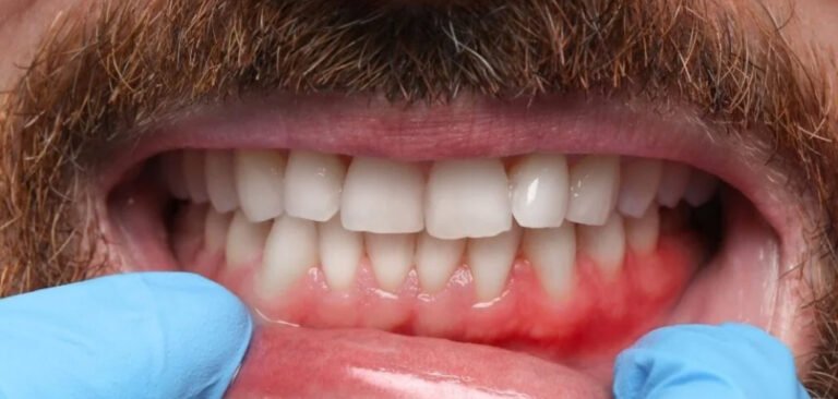 gum disease stages showing red and inflamed gums