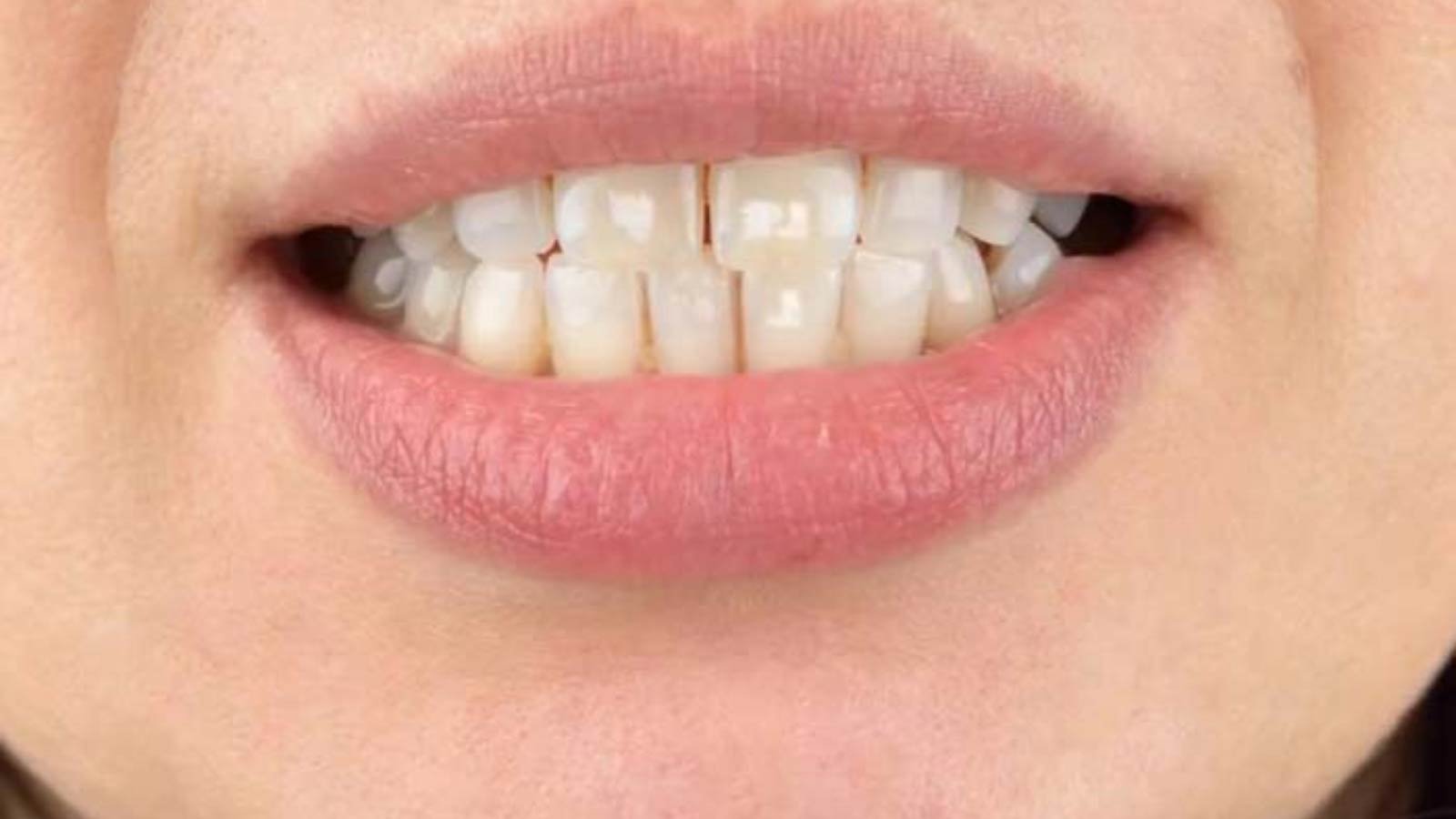 white spots on teeth
