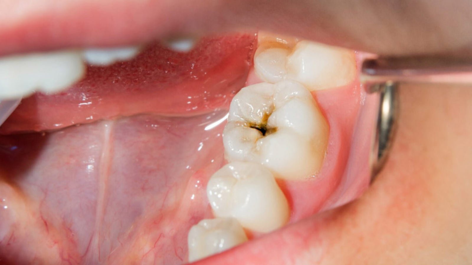 how to tell if you have a cavity