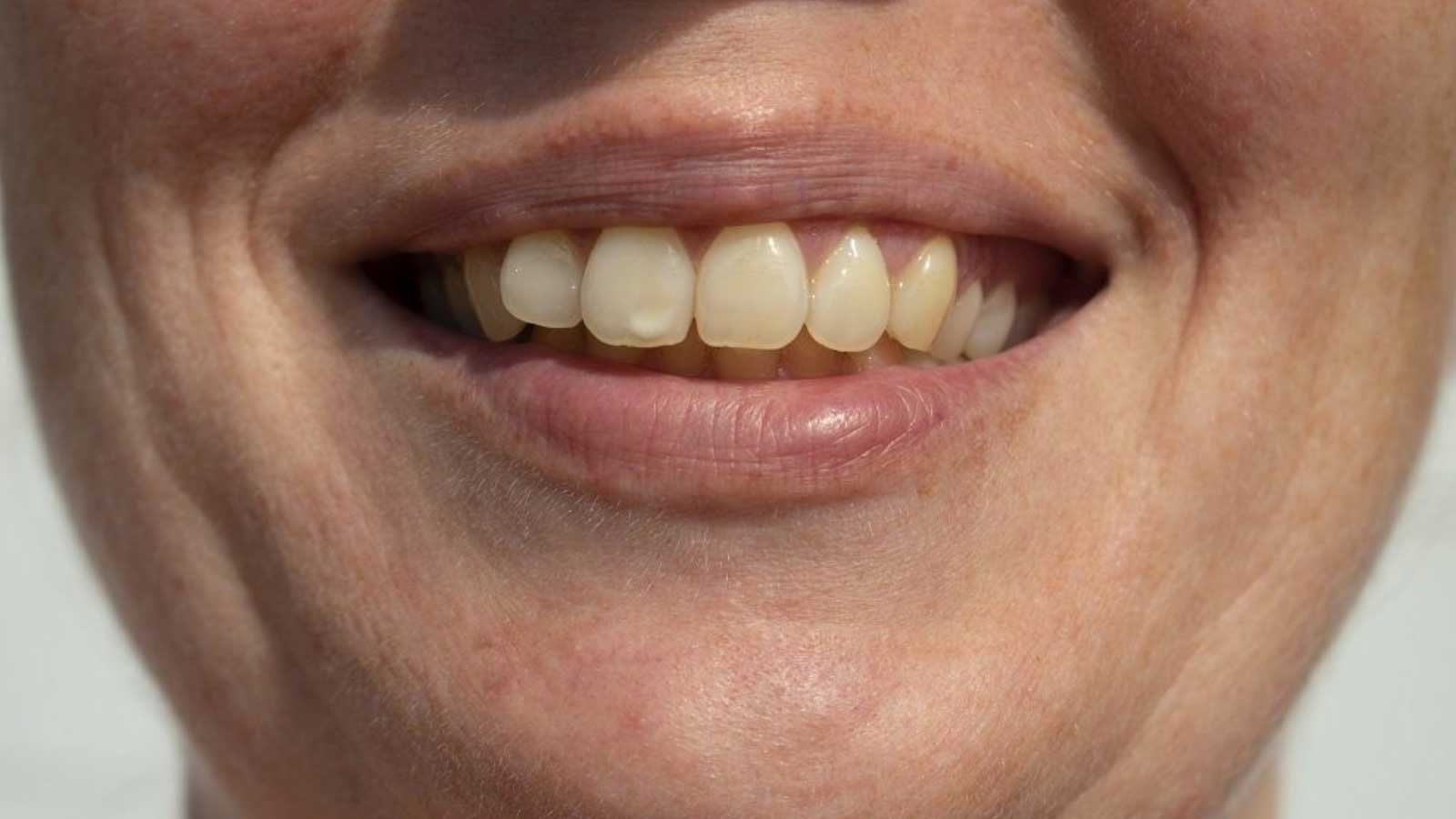 white spots on teeth
